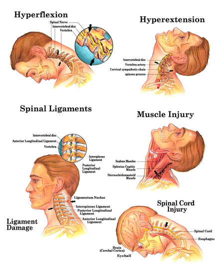 whiplash injury